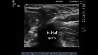 ultrasound guided pudendal nerve block [upl. by Leddy]