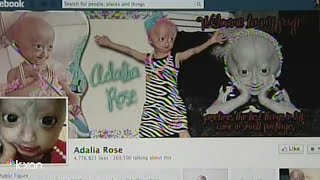 Adalia Rose Austinite social media star with rare genetic condition dies at 15 [upl. by Brozak]