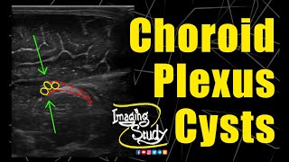 Choroid Plexus Cysts  Neonate  Ultrasound  Case 253 [upl. by Norej]