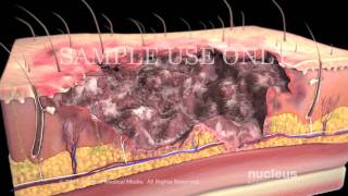 Burns Classification and Treatment [upl. by Ayotel]