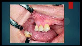 Oral Surgery L1 Preprosthetic Surgery [upl. by Notserp]