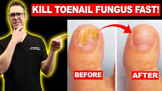 1 BEST Toenail Fungus Treatment Top 10 Home Remedies 2024 [upl. by Samohtnhoj]