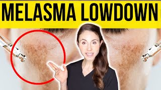 Get The Lowdown On Melasma From A Dermatologist [upl. by Ominorej]