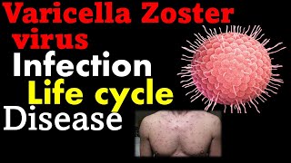 Varicella zoster virus pathogenesis  chickenpox virus [upl. by Sirc]