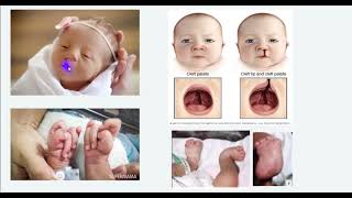 Edwards syndrome متلازمة ادوارد [upl. by Jermaine72]