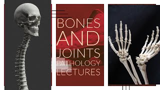 BONES AND JOINTS PATHOLOGY lecture 9 CHONDROMA OSTEOCHONDROMA AND CHONDROSARCOMA all imp points [upl. by Bob400]