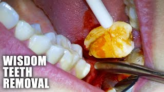 Full Wisdom Teeth Removal Procedure Emergency Extraction of Impacted amp Partially Erupted Molar [upl. by Anyat]