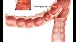 What is a Colon Polyp  Los Angeles Colonoscopy [upl. by Inalaeham]