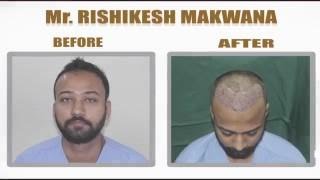 Hair Transplant Review Ahmedabad  Avenues Clinic [upl. by Adaliah]