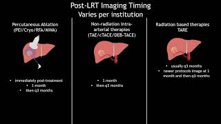 36 Hepatocellular Carcinoma LIRADS Treatment Response after locoregional therapy  Part 1 [upl. by Adnam210]