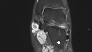 Plantar Fibromatosis [upl. by Lavine]