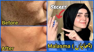 How To Get Rid Of Malasma  Best Medicated Cream 100 Effective  Self Experienced  Dietitian Aqsa [upl. by Hgielsa881]