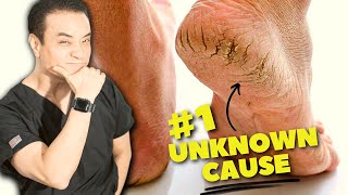 DONT DO THIS 7 Surprising Causes Of Cracked Heels [upl. by Anirtal]