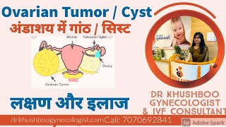 Ovarian Cyst  Ovarian Tumor Symptoms ampTreatment in Hindi  Dr Khushboo Gynecologist in Patna [upl. by Meneau165]