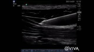 rectus sheath block and subcostal tap block [upl. by Keithley]