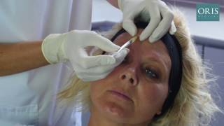 Frontalis Treatments with Botox [upl. by Kletter]