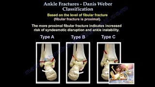 Ankle Fractures Danis Weber Classification  Everything You Need To Know  Dr Nabil Ebraheim [upl. by Almeeta]