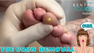 Toe Corn Removal feet toe κεντροποδιου foot podologos calluses podiatrist corn footcare [upl. by Aramac]