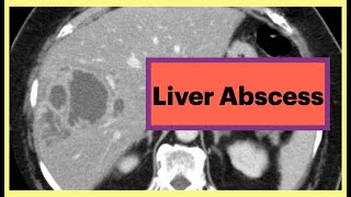 Liver Abscess Radiology Radiology Liver Surgery [upl. by Nagle]