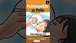 Poliomyelitis Hindi  Polio  Polio Virus  Causes Signs and Symptoms Polio Poliomyelitis [upl. by Yedok]