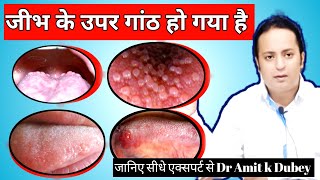 जीभ के उपर गांठ हो तो कैसे ठीक करें। How To Cure Swelling On Tounge [upl. by Joshua649]