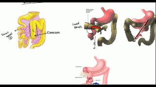 Gut Malrotation Nonrotation and Volvulus for USMLE [upl. by Euqina]