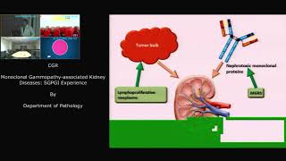 Monoclonal Gammopathy associated Kidney [upl. by Noreh]