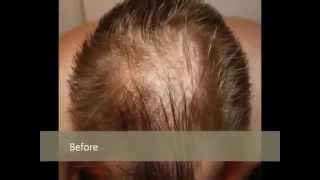 Lipogaine Review  Lipogaine Before and After  Grow Your Hair  Hair Treatments  Hair Growth [upl. by Laud]