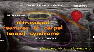 Ultrasound Features of Carpel Tunnel Syndrome [upl. by Itsrik553]