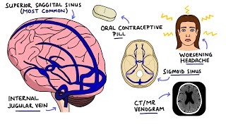 Cerebral Venous Sinus Thrombosis CVST  With Dural Venous Sinuses Anatomy [upl. by Nicholas147]