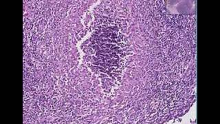 Histopathology Lymph nodeTularemia [upl. by Imoan]