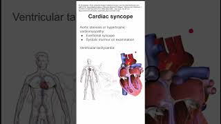 Cardiac syncope [upl. by Correna]