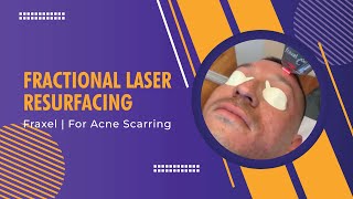 Fractional Laser Resurfacing  Fraxel  For Acne Scarring  Dr Jason Emer [upl. by Ahsinyt573]