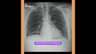 Pneumoperitoneum  XRay pneumoperitoneum meremehboob shilparao tseries xray triptidimri song [upl. by Chatterjee]