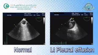 060 Pleural Effusion TEE KAMC [upl. by Triley]