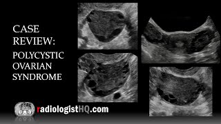 Ultrasound of Polycystic Ovarian Syndrome [upl. by Hrutkay]