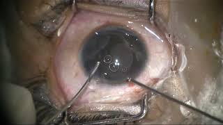 Triple treatment therapy for congenital stromal iris cyst [upl. by Rosenkranz476]