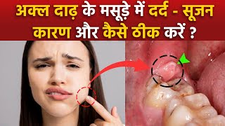 Pericoronitis Treatment At Home Akal Daad Ke Masude Fulne Ka Ilaj Wisdom Teeth Gum Swelling Remedy [upl. by Neleb]