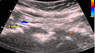 COMMON ILIAC ARTERY STENOSIS [upl. by Senoj]