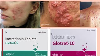 Glotret tablets 5102030mg treatment in nodulocystic acne oily skinacne pimples treatment [upl. by Rezeile320]