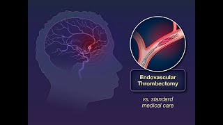 Endovascular Thrombectomy A Key Strategy for Stroke Treatment [upl. by Giff667]