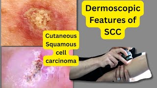 Dermoscopic features of SCCSquamous Cell Carcinoma [upl. by Bellamy]