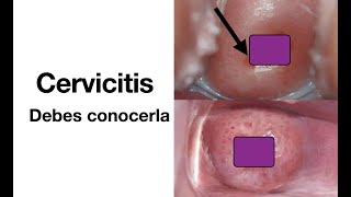 Cervicitis  Causas síntomas diagnóstico y tratamiento  ETS [upl. by Gardie]