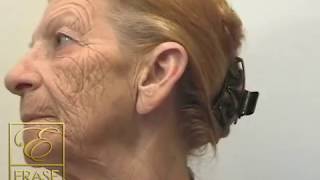 anti aging cream  worlds best fast acting anti aging wrinkle cream demonstration [upl. by Hanima]