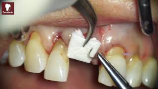 Socket Preservation in a case of buccal plate dehiscence [upl. by Oak172]