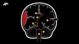 Brain Herniation Syndromes [upl. by Etteniotna]