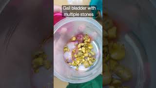 Gall bladder with Multiple stones healthmedia [upl. by Elorac]