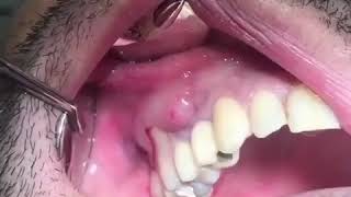 Popping a Tooth Abscess [upl. by Aztinay]