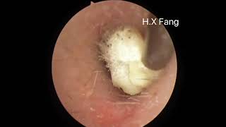 Ear wax and Dead skin Fungus cleaning耳垢和死皮清理真菌感染清理20230828 [upl. by Arbmik]