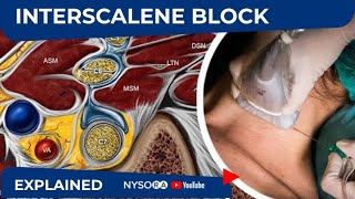 NYSORA Regional Anesthesia Interscalene Block [upl. by Nunciata512]